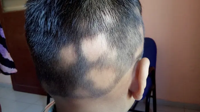 Alopecia Areata case 4 before treatment